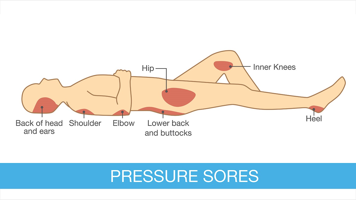 زخم فشاری یا زخم بستر چیست ؟ 
